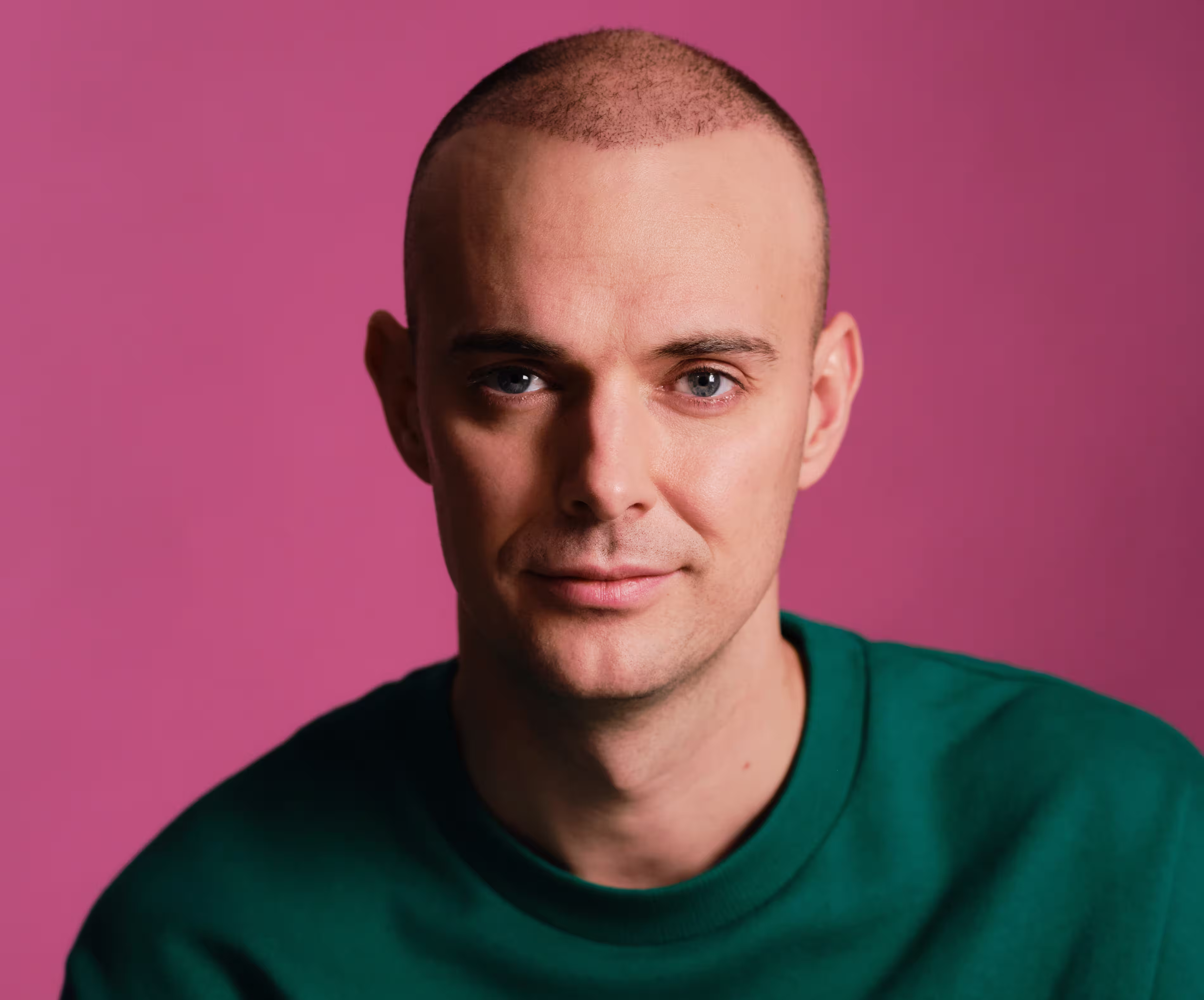 I have not been seen in public without a hat for 10 years. Would a Turkish hair transplant change my life?